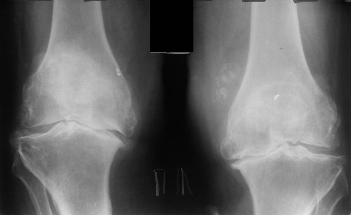 x-ray of knee joints with arthrosis