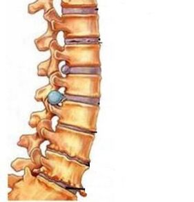 how osteochondrosis of the cervical region develops