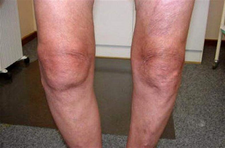 swollen knee due to arthritis