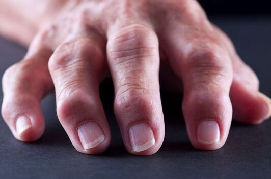 Articular deformities of the fingers due to arthrosis or arthritis